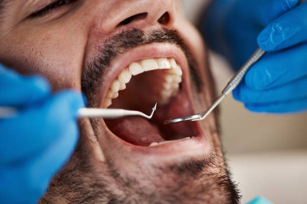 Best Emergency Root Canal Treatment in Myrtle Grove, FL